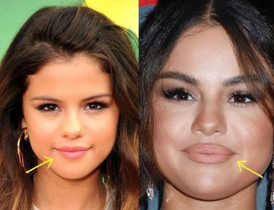 Selena Gomez e pranon: Kam përdorur botox-in!
