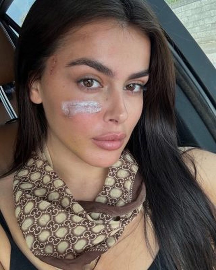 U godit nga motrat Berisha, Klea Prenga nxjerr foton e re: Si duket fytyra e saj