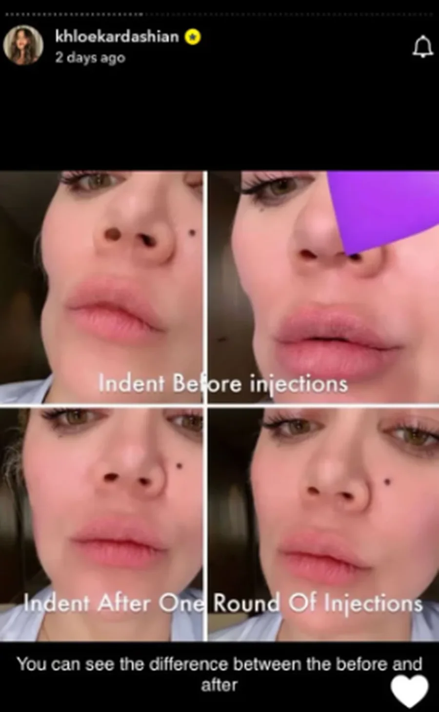 Khloe Kardashian, kanceri i lëkurës: Mbushi me injeksione gropën