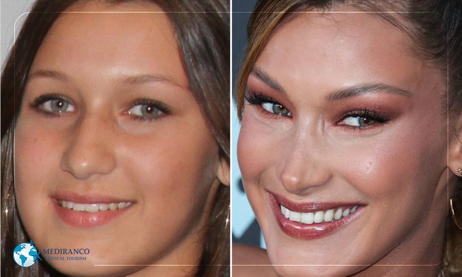 Një nga femrat më të bukura në botë, por Bella Hadid