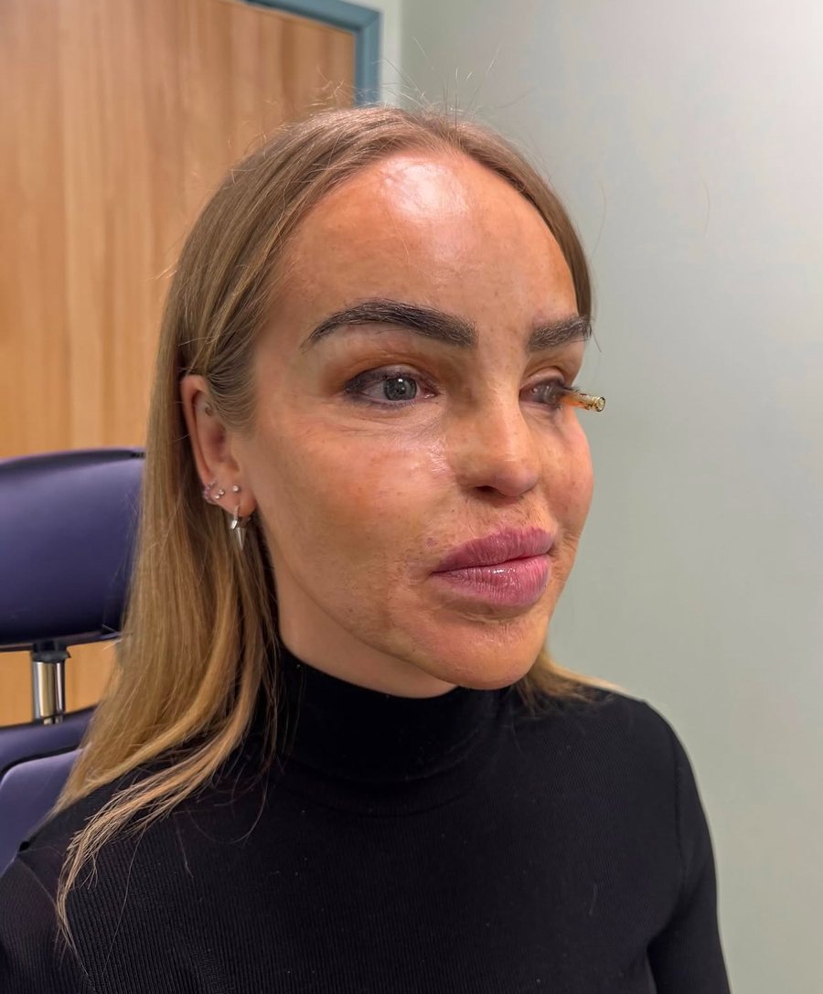 16 vite pas sulmit me acid, Katie Piper bën ndryshimin në pamjen e saj