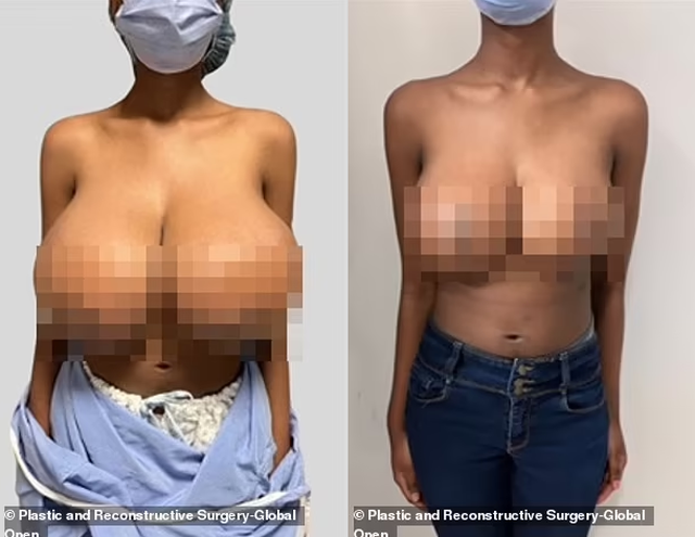 FOTO/ Dhjetëra gra britanike raportuan rritje të gjoksit pas