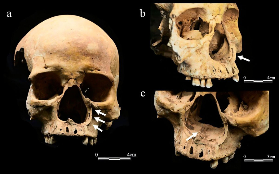 Dinastia Yuan   Grua pa hundë   Skeleti tregon ndëshkimin e tmerrshëm në Kinën mesjetare